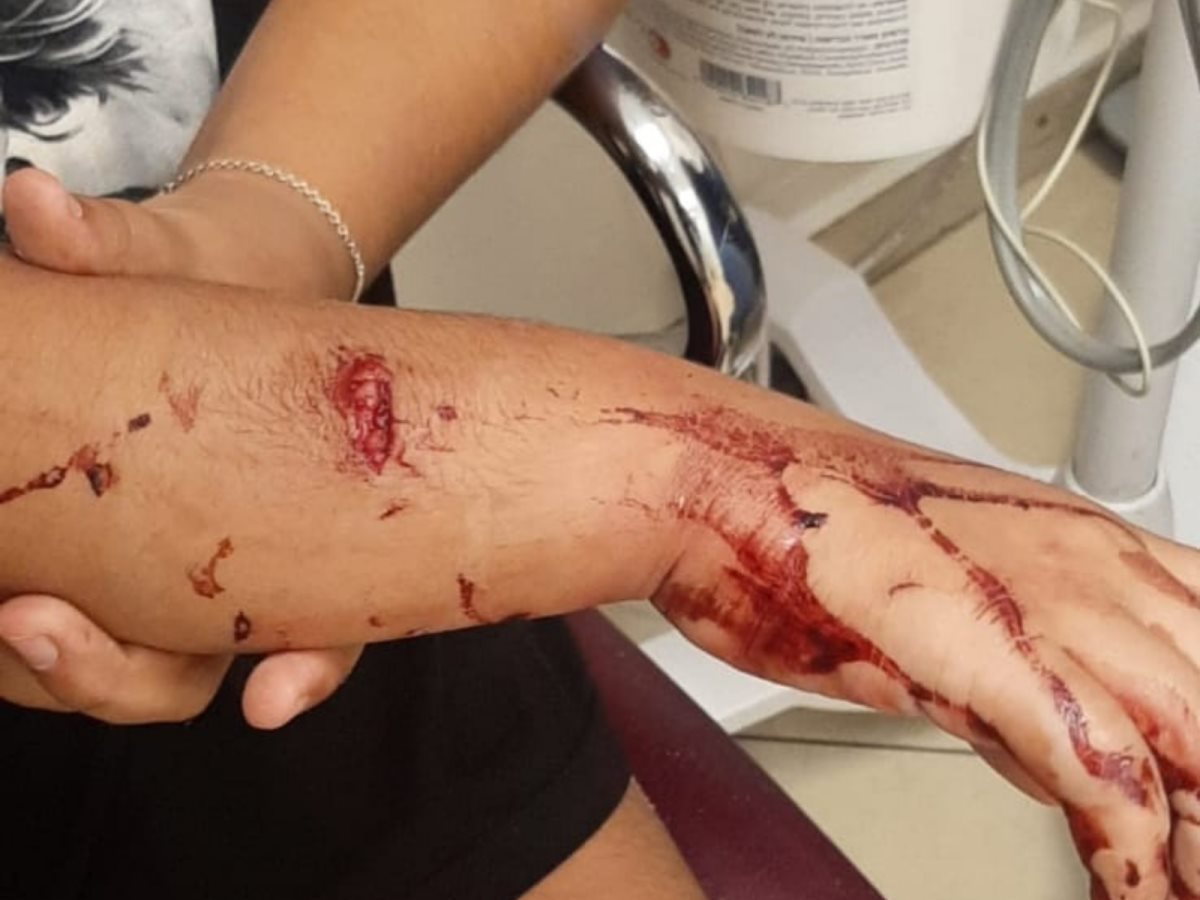 הילדה לאחר הנשיכה. צילום באדיבות המשפחה