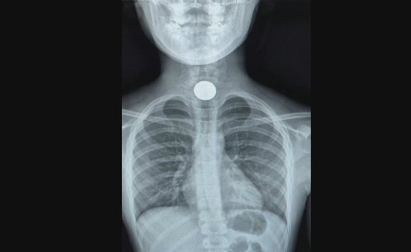 המטבע כפי שצולם ברנטגן