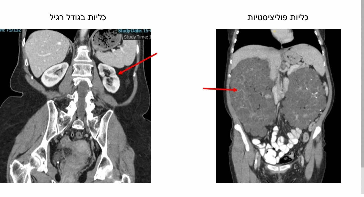 הלכיות המוגדלות מימין, לעומת כליות תקינות משמאל. אסותא