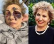 הפציעה שהובילה לגילוי גידול והשיקום שאחרי: השרה לשעבר סופה לנדבר בפוסט חושפני